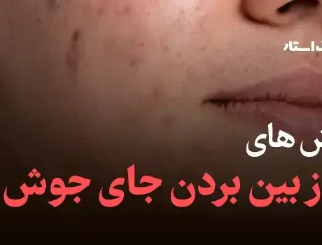 روش های از بین بردن جای جوش